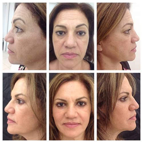 Rejuvenecimiento facial
